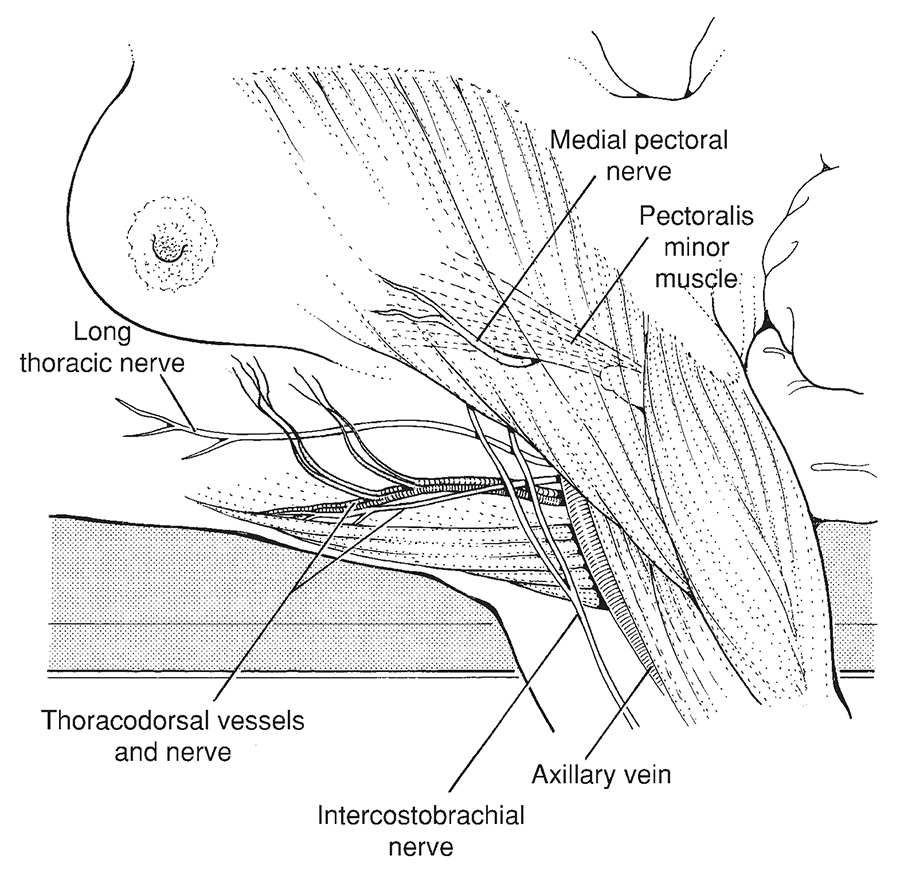 Major neurovascular structures preserved during axillary dissection: long thoracic nerve, thoracodorsal vessels and nerve, intercostobrachial nerve, medial pectoral nerve and axillary vein