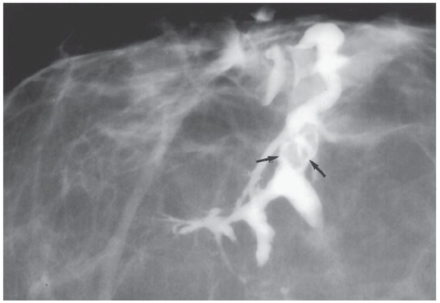 Ductogram showing a large intraductal filling defect representing an intraductal papilloma