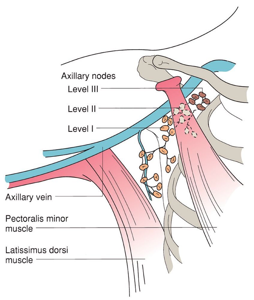 The three levels of axillary lymph nodes defined by their relation to the pectoralis minor muscle