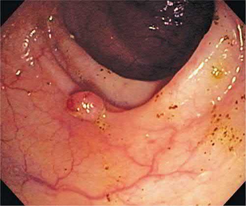 Colonoscopic view of a small pedunculated colonic polyp amenable to snare polypectomy