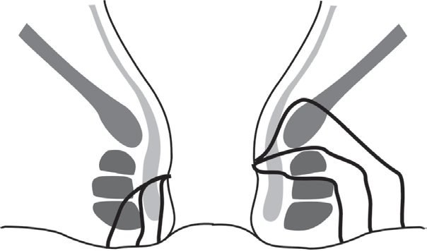 Classification of fistula-in-ano by the course of the track relative to the sphincter complex, showing low (submucosal, intersphincteric, low trans-sphincteric) and high (high trans-sphincteric, suprasphincteric, extrasphincteric) fistulae