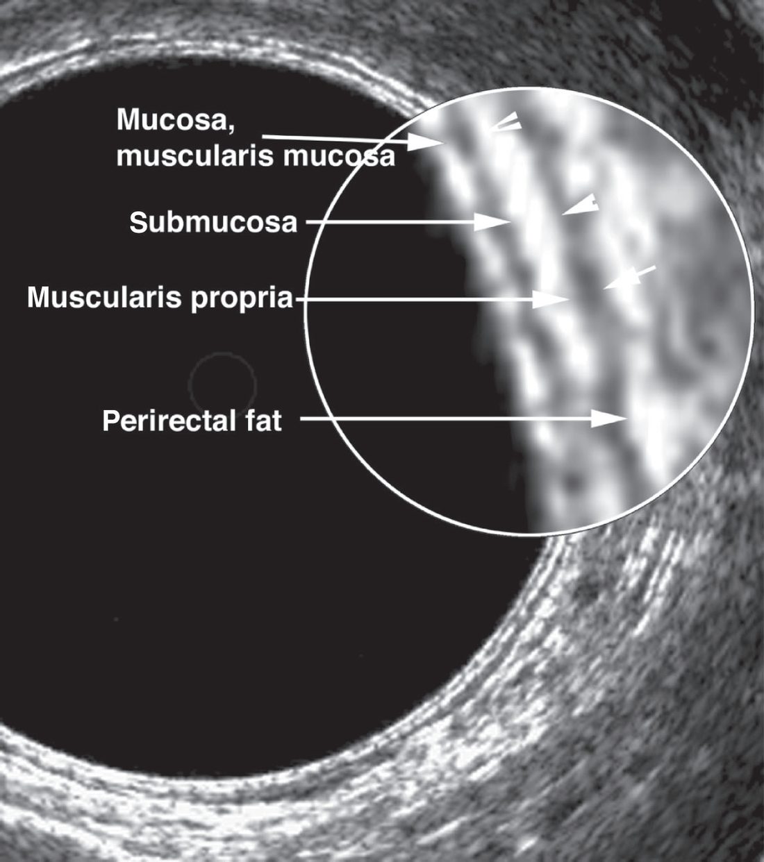Normal endorectal ultrasonography demonstrating the layered structure of the rectal wall