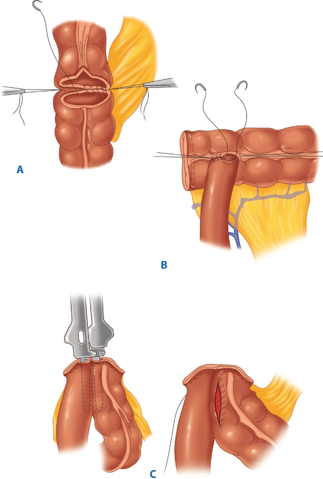 Anastomotic techniques after colonic resection: sutured end-to-end colocolic, sutured end-to-side ileocolic, and stapled side-to-side (functional end-to-end) ileocolic anastomoses