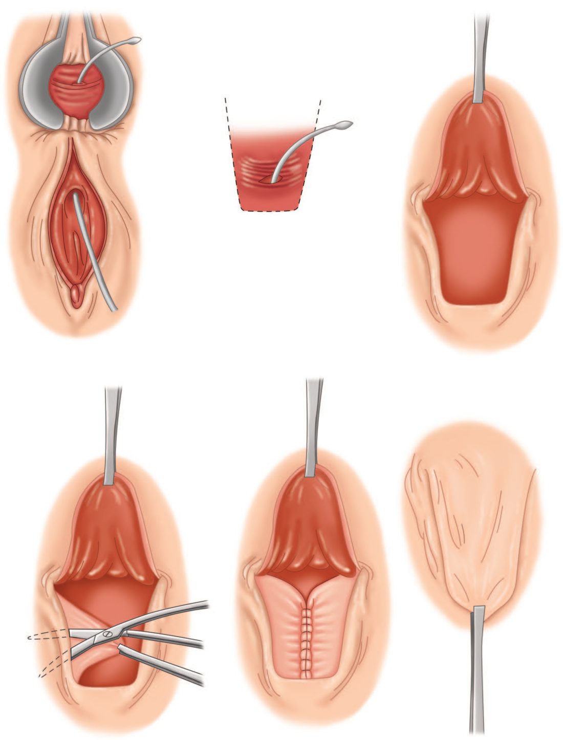 Steps of an endorectal advancement flap repair, illustrated for a rectovaginal fistula