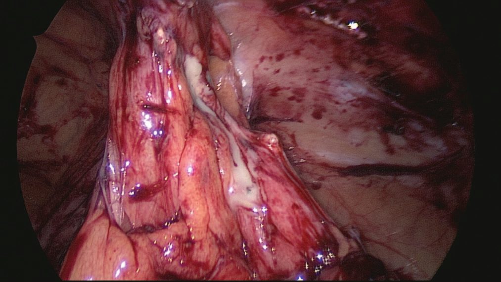 Gangrenous appendicitis with perforation seen at laparoscopy