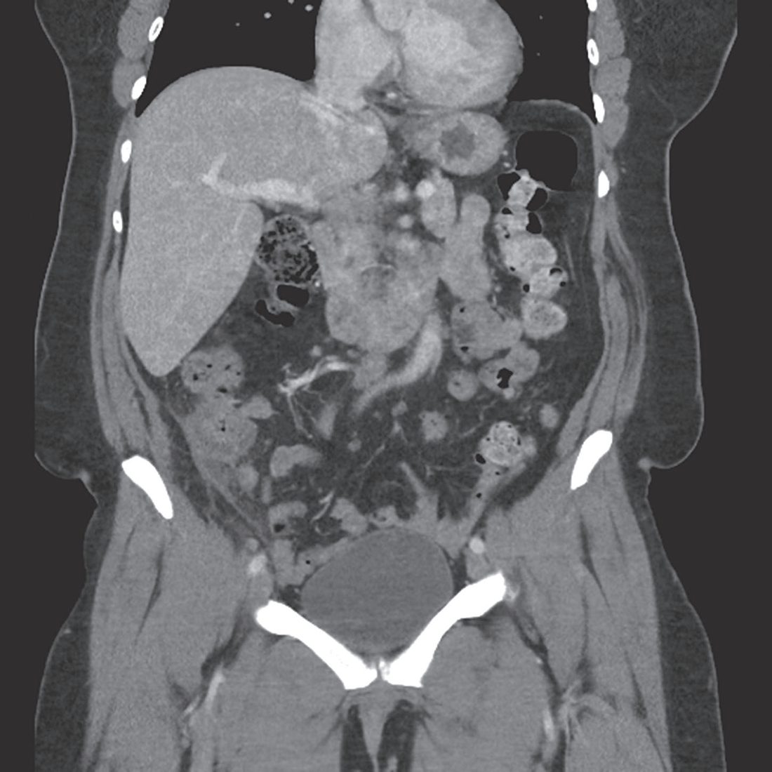 Coronal CT showing inflammatory changes of the appendix without abscess, consistent with uncomplicated acute appendicitis
