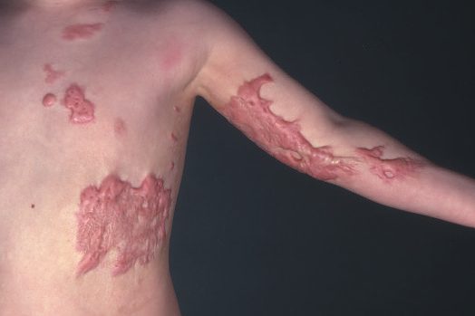 Multiple keloid scars