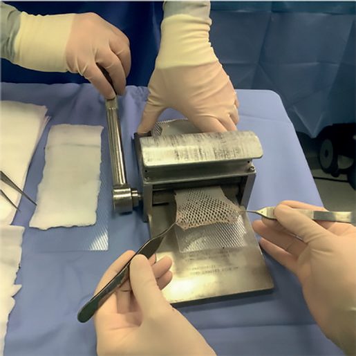 Meshing a split-thickness skin graft