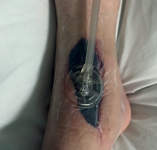 Negative-pressure wound therapy for a lower limb wound