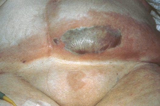 Pressure ulcer