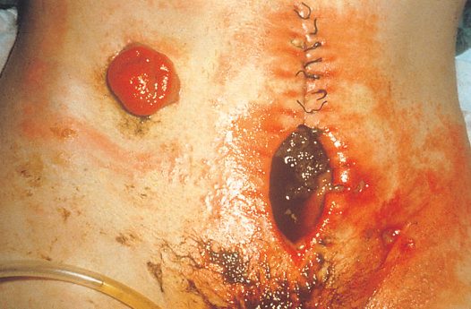 Major wound infection and delayed healing presenting as a faecal fistula in a patient with Crohn's disease on steroid treatment
