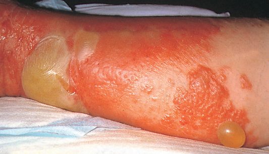 Streptococcal cellulitis of the leg following a minor puncture wound
