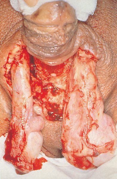 A classic presentation of Fournier's gangrene of the scrotum with 'shameful exposure of the testes' following excision of the gangrenous skin