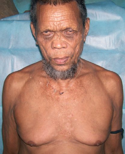 Bilateral gynaecomastia, seen here with the typical leonine facies of leprosy
