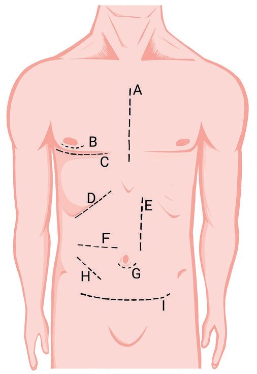 Skin incisions in general surgery (A-I): sternotomy, periareolar, inframammary, subcostal, paramedian, transverse, periumbilical, McBurney's and Pfannenstiel