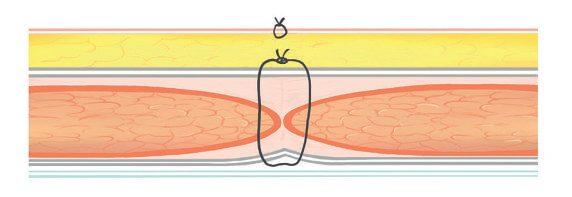 Mass closure of all musculoaponeurotic layers of the abdominal wall
