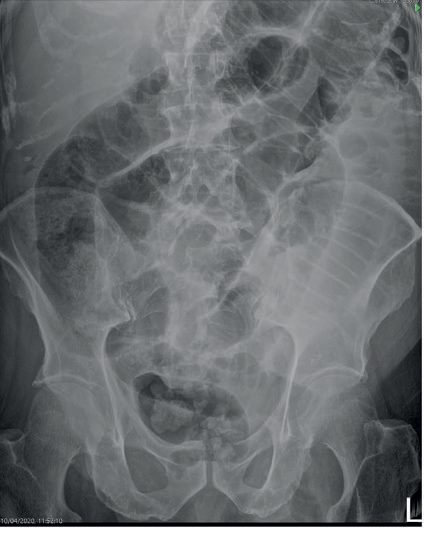 Supine abdominal radiograph in small bowel obstruction showing multiple dilated small bowel loops