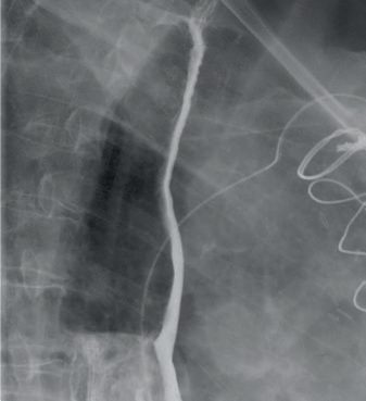 Barium swallow examination showing a malignant stricture due to an oesophageal carcinoma