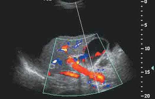 Sagittal ultrasound of the liver in cirrhosis, showing nodularity of the surface