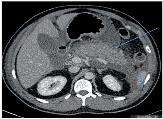 Axial computed tomography in acute pancreatitis showing a swollen oedematous pancreas (arrow) with extensive peripancreatic free fluid (curly arrow)