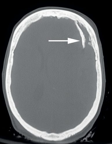 Computed tomography of the head after head trauma showing a skull fracture with a large depressed component (arrow)