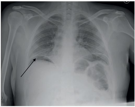 Erect chest radiograph showing subdiaphragmatic free gas (arrow) consistent with hollow organ perforation