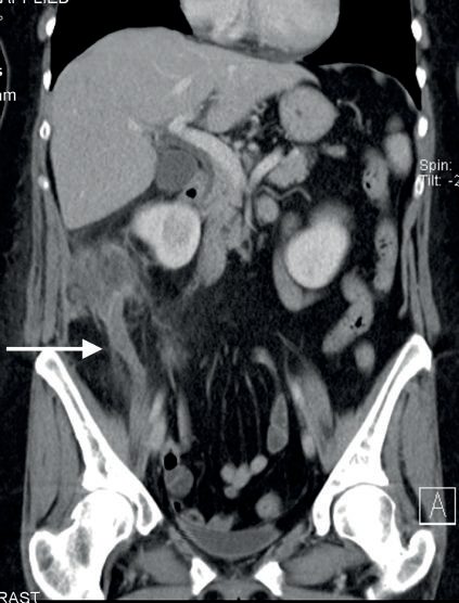 Acute appendicitis: contrast-enhanced computed tomography reconstructed in the coronal plane demonstrates a thickened appendix in the right iliac fossa (arrow) with inflammatory changes in the surrounding fat