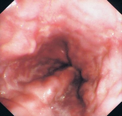Grade 2 oesophageal varices, treatable by application of bands to ligate the vessels