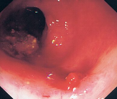 Endoscopic haemostasis of a bleeding gastric ulcer: active bleeding (a) is first treated with adrenaline injection to achieve haemostasis (b), then two haemoclips are applied to prevent rebleeding (c and d)