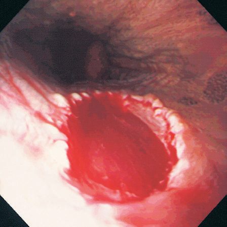 Endoscopic mucosal resection used to remove an early gastric cancer, leaving a clean base