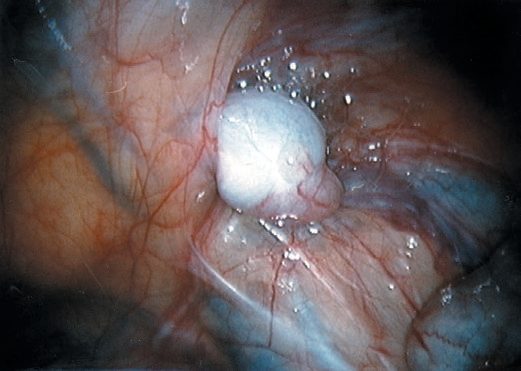 Laparoscopic view of a right-sided intra-abdominal testis visible at the internal ring. Vas (single arrow) and testicular vessels (double arrow)