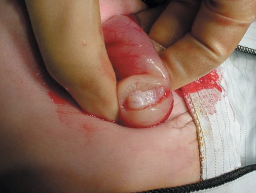 Pyloromyotomy for infantile hypertrophic pyloric stenosis