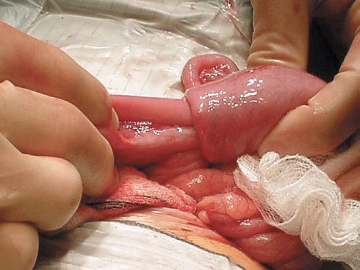 Ileocolic intussusception causing small bowel obstruction
