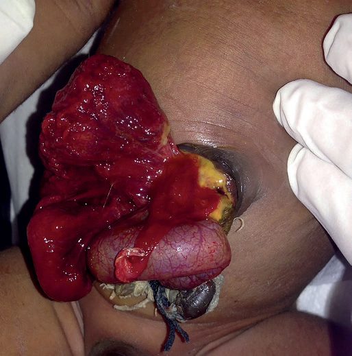 Barium enema in an infant showing the transition zone in the proximal sigmoid colon, between dilated proximal bowel and the narrow aganglionic segment
