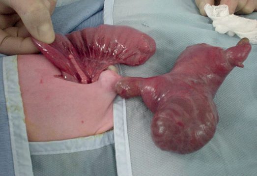 Closing gastroschisis: the defect has narrowed and occluded the vessels to a few loops of intestine, with an atresia found at laparotomy