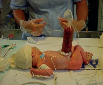 Gastroschisis managed in a preformed silo, allowing staged reduction of the eviscerated bowel
