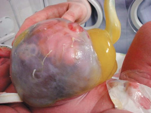 Exomphalos major, the herniated viscera contained within an intact membranous sac at the base of the umbilical cord