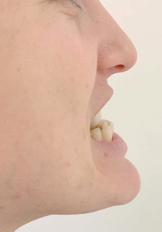Ability to protrude the jaw, assessed preoperatively as a predictor of difficult airway management