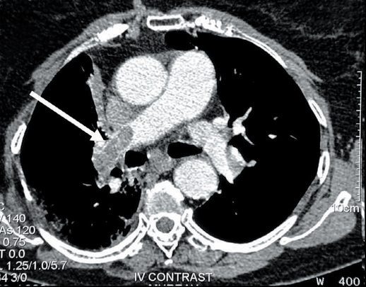 Computed tomography scan showing a pulmonary artery blood embolism (arrow)