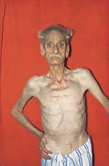 Severely malnourished patient with evidence of fat and muscle wasting