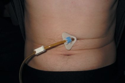 Percutaneous endoscopic gastrostomy tube, showing the external bumper and tube clamp