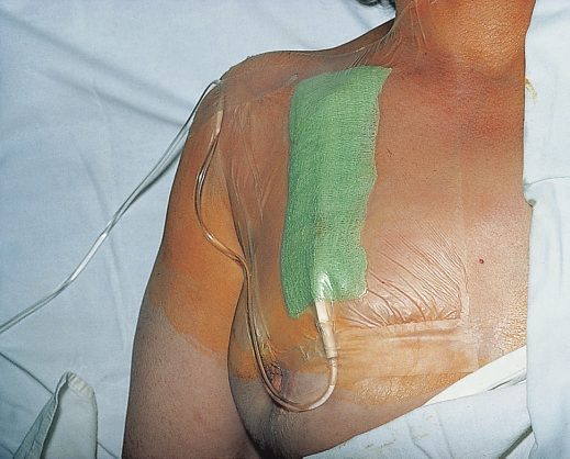A central venous line (in this case a subclavian line) used for administration of parenteral nutrition