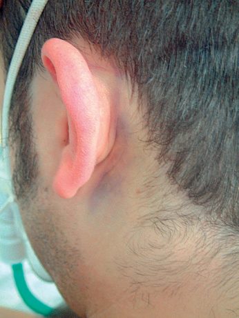 Battle's sign: bruising over the mastoid process, which may accompany a skull base fracture