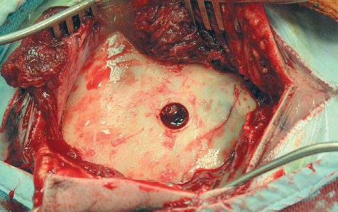 A large left extradural haematoma, biconvex in shape and exerting mass effect