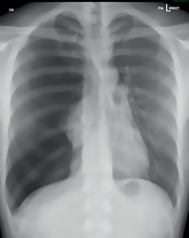 Radiological appearance of a tension pneumothorax