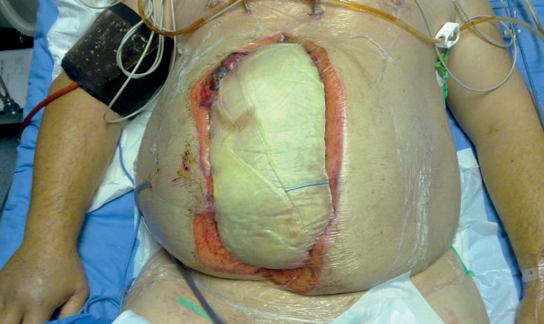 Abdominal closure following damage control surgery, showing a temporary adhesive-film (OPSITE) skin closure
