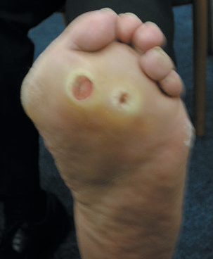 Plantar neuropathic diabetic foot ulcers at pressure points on the sole