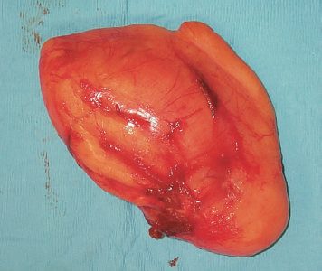 Excised benign lipoma