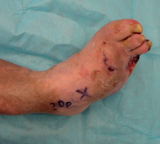 Severe diabetic foot infection in a neuropathic foot with marked necrosis and tissue loss and hindfoot deformity