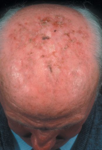 Actinic keratosis on a sun-damaged bald scalp - a premalignant precursor of squamous cell carcinoma